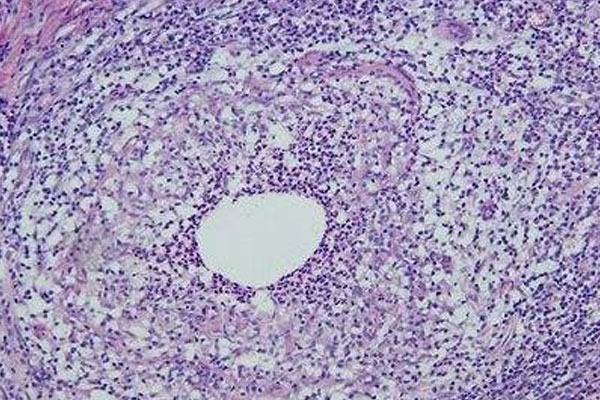 如何区分急性乳腺炎和浆