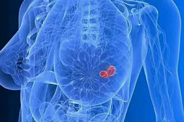 浆细胞性乳腺炎是咋回事