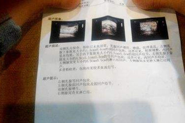 浆细胞性乳腺炎咋治