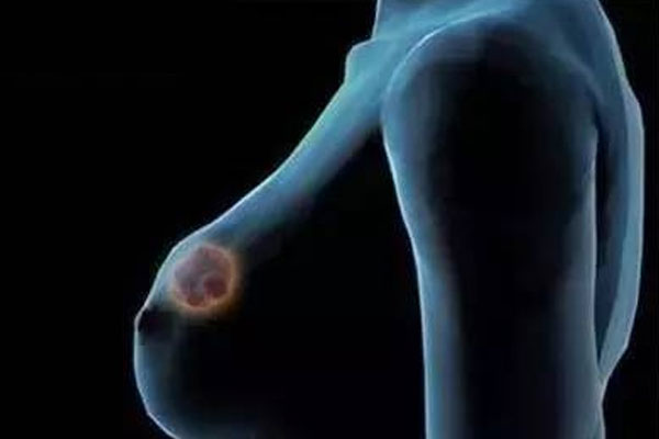 南昌乳腺病专业 乳腺结节