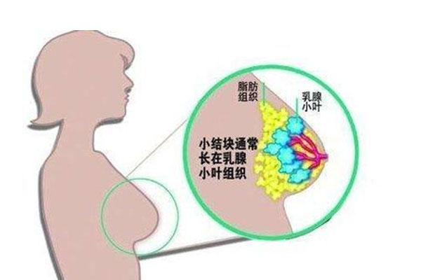 乳腺多发结节的病因