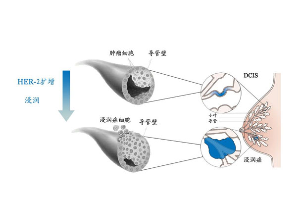什么是乳腺瘘管Zuska病?