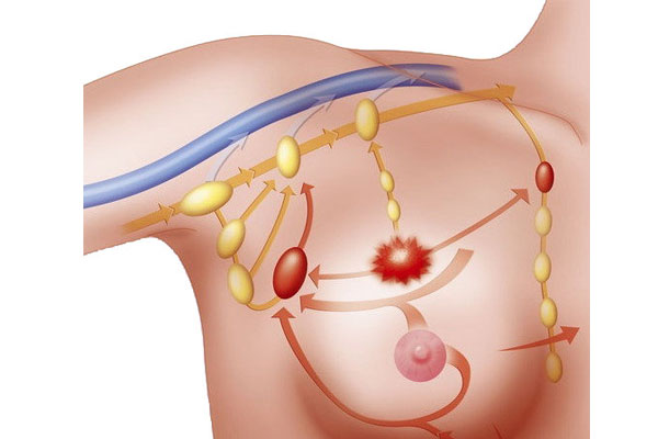 男女均可发病的乳管瘘究