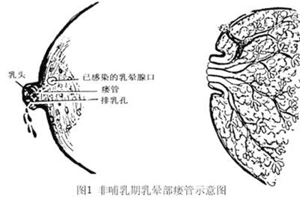 乳腺导管漏要怎么治疗