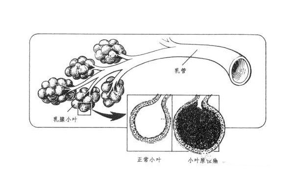 女性乳腺导管漏有什么症