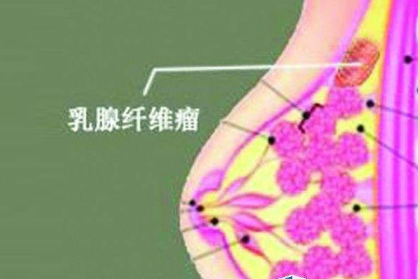 得了乳腺纤维瘤，要微创