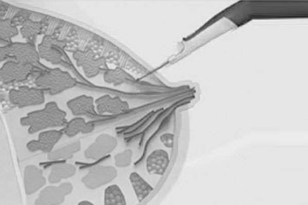 乳腺导管内乳头状瘤和乳