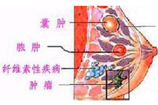 乳腺囊肿是怎么回事?